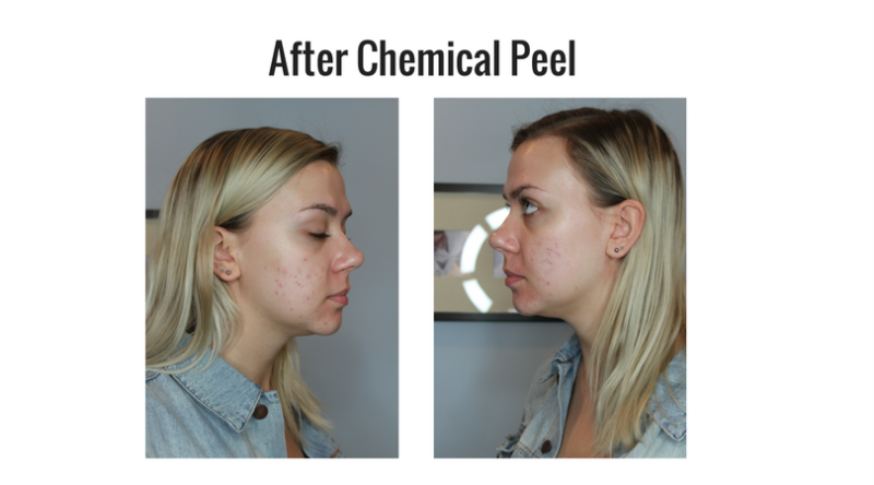 chemical peels