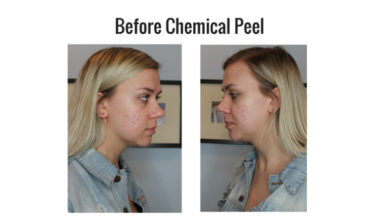 chemical peels